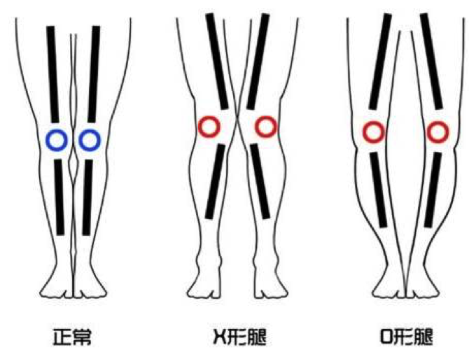 一,什么是x型腿和o型腿?